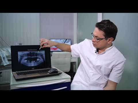 Видео: Стабилизация протезов за счет альвеолярного гребня. Что делать при атрофии?