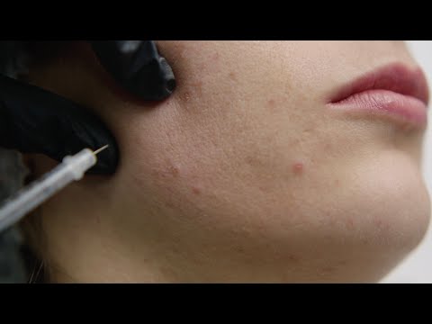 Видео: Ботокс в долната част на лицето в Derma-Act