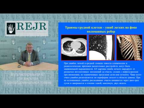 Видео: Мультиспиральная КТ в диагностике тупой торакальной и абдоминальной травмы
