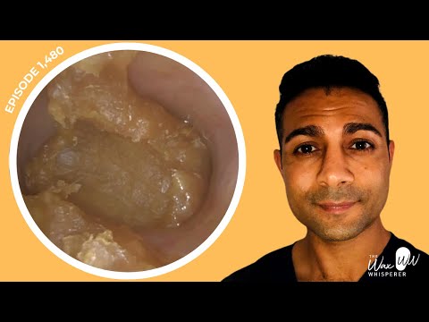 Видео: 1480 — ежегодное хроническое накопление ушной серы удалено | Узнайте больше о слуховом пути