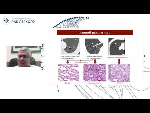Видео: Как принять правильное решение об операбельности местнораспространенного рака легкого в рамках МДК?