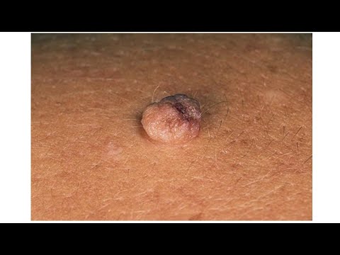 Видео: 01-19. Эпителиальные опухоли. Герминогенные опухоли.