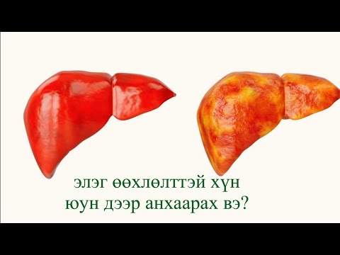 Видео: элэг өөхлөлттэй хүний амьдралын хэв маяг, хооллолт, дасгал хөдөлгөөн