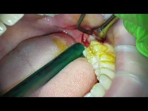 Видео: Удаление зуба "мудрости" с ультразвуком