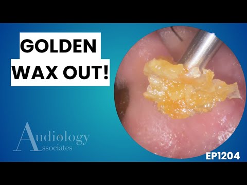 Видео: Экстремальное удаление ушной серы | Удаление золотистой кератиновой пробки и липкой серы - EP1204