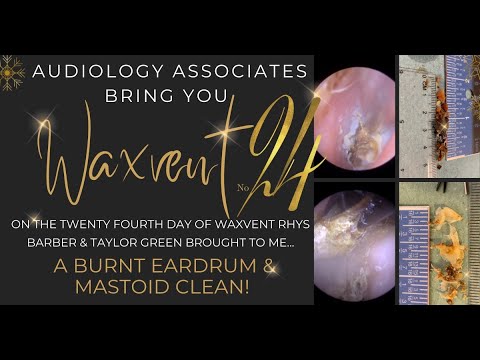 Видео: Чистка обожженной барабанной перепонки и сосцевидной полости - EP543