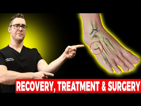 Видео: Пятый перелом плюсневой кости Джонса [Восстановление, лечение и хирургия] 2022!