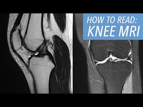 Видео: Как читать МРТ коленного сустава: вводный подход
