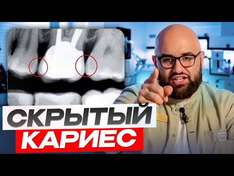 Видео: Скрытый кариес