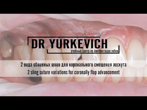 Видео: Обвивной шов и гибридный шов при закрытии рецессии | Sling and hybrid sutures for recession closure