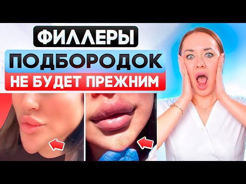 Видео: Филлеры — это опасно? Последствия филлеров в подбородок.
