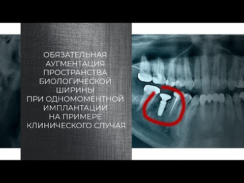 Видео: Аугментация пространства биологической ширины при одномоментной имплантации