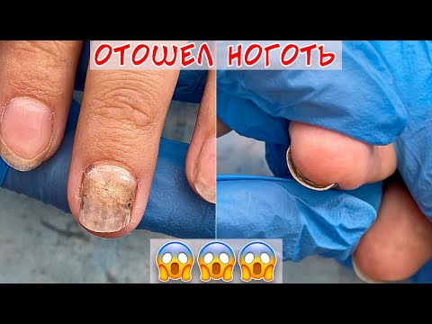 Видео: Онихолизис зачистка ногтя / Отошел ноготь от ногтевого ложа