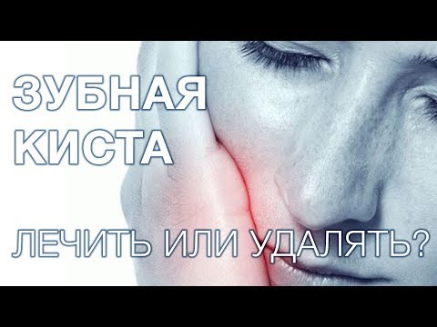 Видео: Киста зуба. Лечить или удалять кисту?