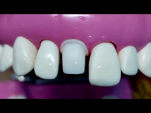 Видео: Как легко выполнить репозицию – Препарирование под цельнокерамическую коронку на верхнюю централь...