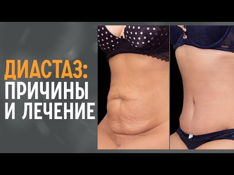 Видео: Упражнения от диастаза после родов | Как его определить и убрать?