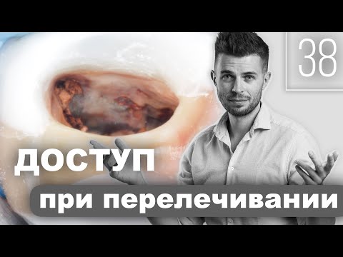 Видео: Эндодонтический доступ и очистка пульпарной камеры при перелечивании. Уроки эндодонтии. Выпуск 38