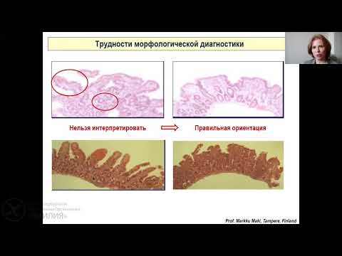 Видео: Целиакия у детей. Лекция №4