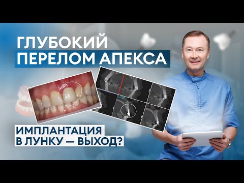 Видео: ПЕРЕЛОМ ПЕРЕДНЕГО ЗУБА! КАК СПРАВИТЬСЯ С КЕЙСОМ? Имплантация в ЛУНКУ, выход?