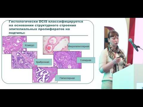 Видео: Протоковый рак in situ. Морфологические варианты и их клиническое значение