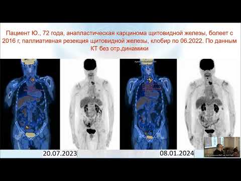 Видео: Современные возможности ПЭТ-КТ при раке щитовидной железы