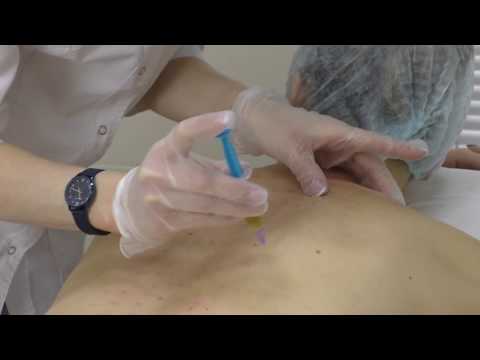 Видео: Мезотерапия
