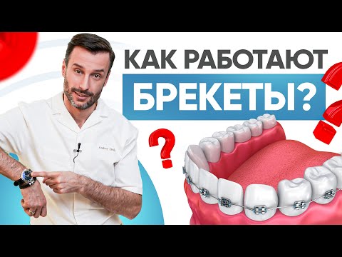 Видео: Как работают брекеты и почему так медленно? Современная ортодонтия