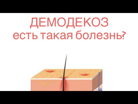 Видео: ДЕМОДЕКОЗ и ДЕМОДЕКС - что это такое