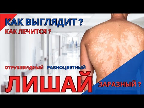 Видео: Лечение и профилактика отрубевидного лишая | Как выглядит разноцветный лишай