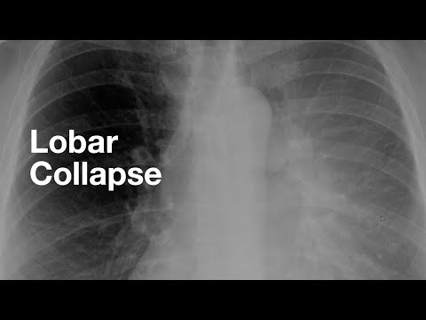 Видео: Коллапс долей (примеры каждой доли)