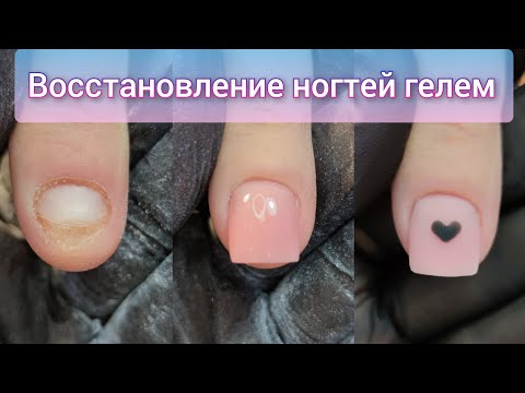 Видео: НАРАЩИВАНИЕ ОБКУСАННЫХ НОГТЕЙ / ОНИХОФАГИЯ / ГРЫЗЕТ НОГТИ / Nails / 指甲延伸 / 修指甲 / 修腳