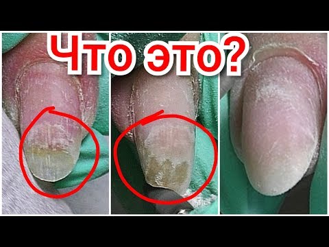 Видео: Жуткие отслойки на ногтях
