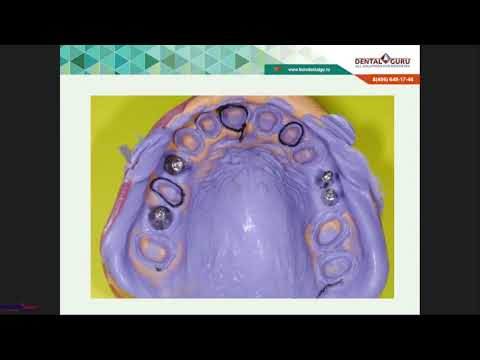 Видео: Вебинар: Снятие слепков(оттисков)