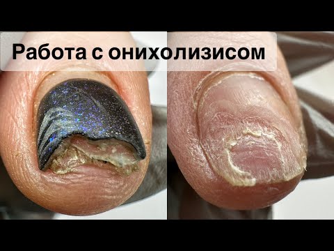 Видео: ОНИХОЛИЗИС.МАНИКЮР ОНЛАЙН. Виктория Авдеева