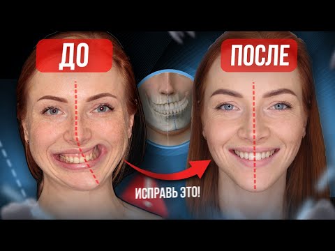 Видео: АСИММЕТРИЯ ЛИЦА, как исправить? ОПЫТ ПАЦИЕНКТИ, как мы убрали асимметрию лица?