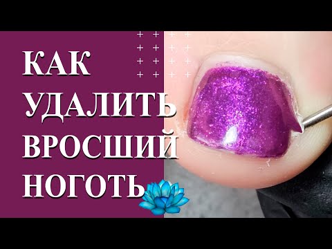 Видео: У клиента вросший ноготь на большом пальце ноги. Как убрать?