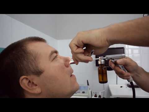 Видео: Лечение гайморита у взрослых. Как вылечить гайморит без прокола? ЯМИК процедура.