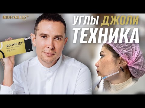 Видео: УГЛЫ ДЖОЛИ | СКУЛЫ контурная пластика #скулы #углыджоли #biohyalux