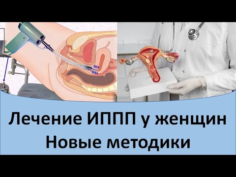 Видео: Лечение ИППП у женщин# Новые методики