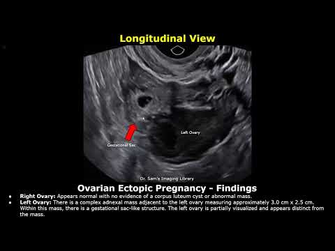 Видео: Отчет об УЗИ внематочной беременности | Трубное, интерстициальное, цервикальное, яичниковое и гет...