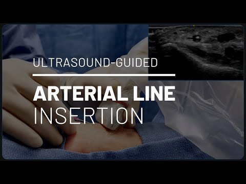 Видео: Установка артериального катетера под контролем УЗИ // Техника с внеплоскостным скосом