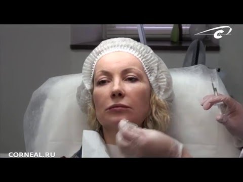 Видео: Коррекция нижней трети лица. PRINCESS®VOLUME.
