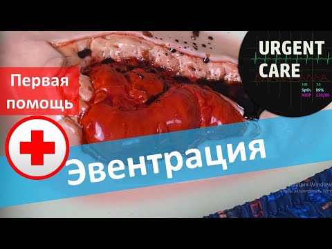 Видео: Первая помощь при эвентрации