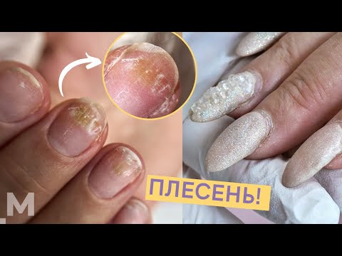 Видео: ПЛЕСЕНЬ НА НОГТЯХ: ЛАЙФХАК 😜 СПЛОШНЫЕ ОТСЛОЙКИ и ТРЕЩИНЫ 😱Как лечить плесень под гель лаком.