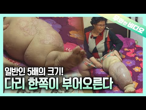 Видео: В 5 раз больше ноги обычного человека!? Женщина, у которой опухла нога