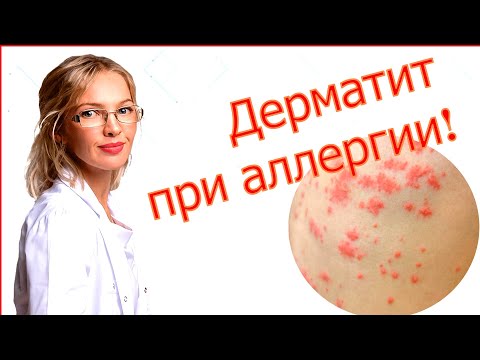 Видео: Как Распознать и Вылечить Аллергический Дерматит