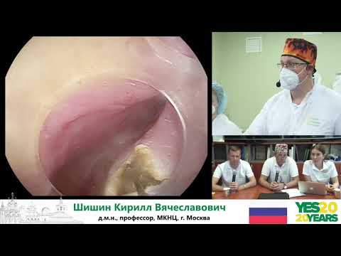 Видео: 28. Дивертикул Ценкера. К. В. Шишин