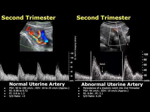 Видео: Спектральная допплерография маточных артерий: нормальные и патологические изображения | УЗИ матки...