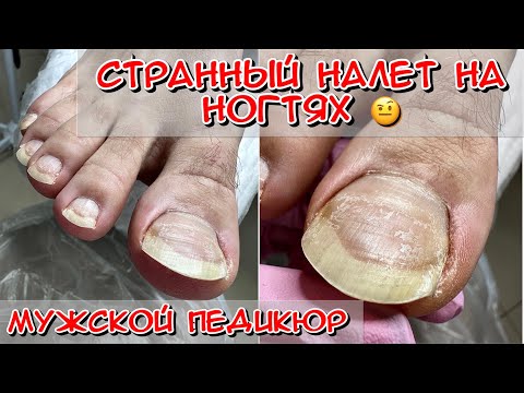 Видео: Мужской педикюр / Странный налет на ногтях /