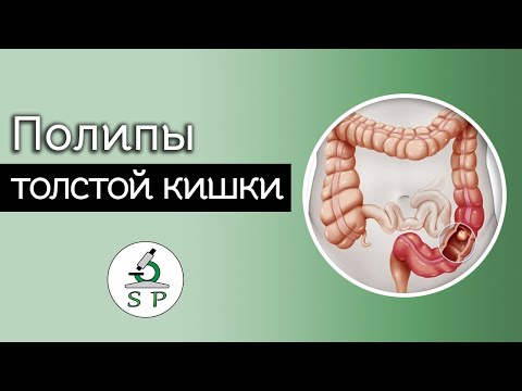 Видео: Полипы толстой кишки | Частная патология